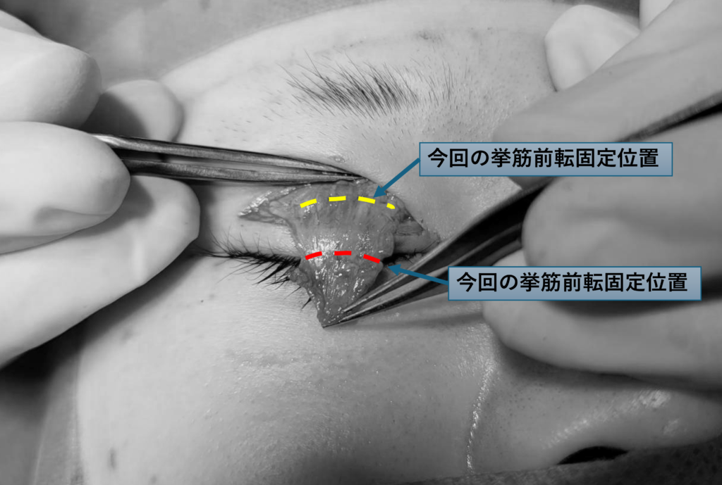全切開修正 眼瞼下垂修正 挙筋群前転 目頭切開