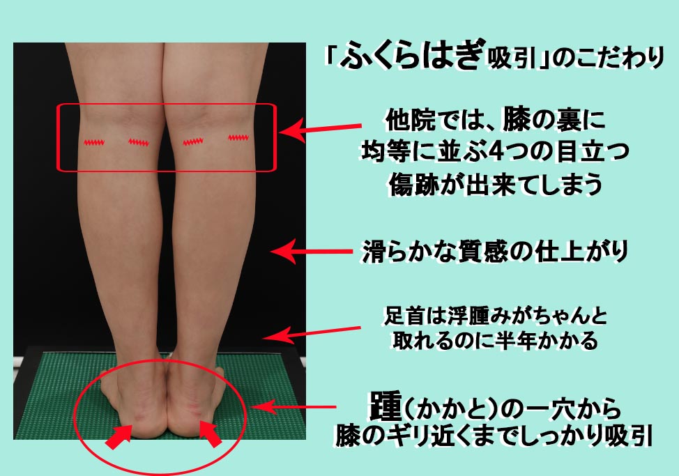 ふくらはぎの脂肪吸引のポイント