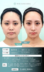 輪郭3点後のビフォーアフター