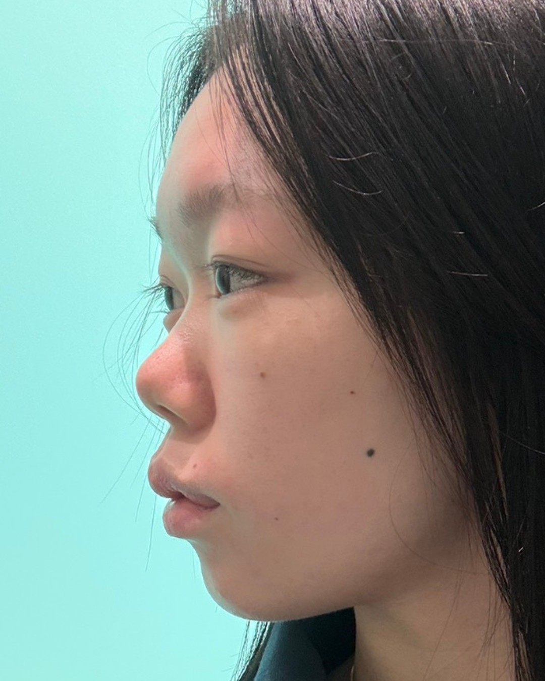 短い鼻・鼻の穴が見える状態をバランス良く BEFORE写真