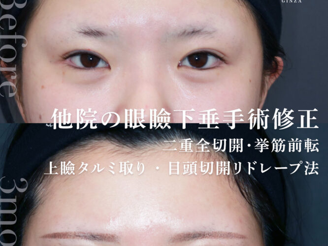 全切開修正　眼瞼下垂修正　挙筋群前転　目頭切開