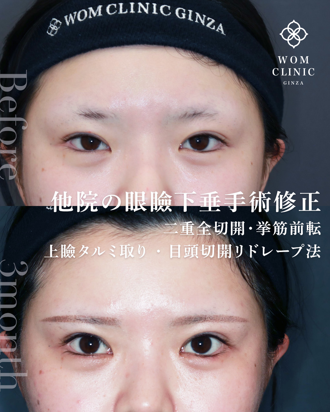 全切開修正　眼瞼下垂修正　挙筋群前転　目頭切開
