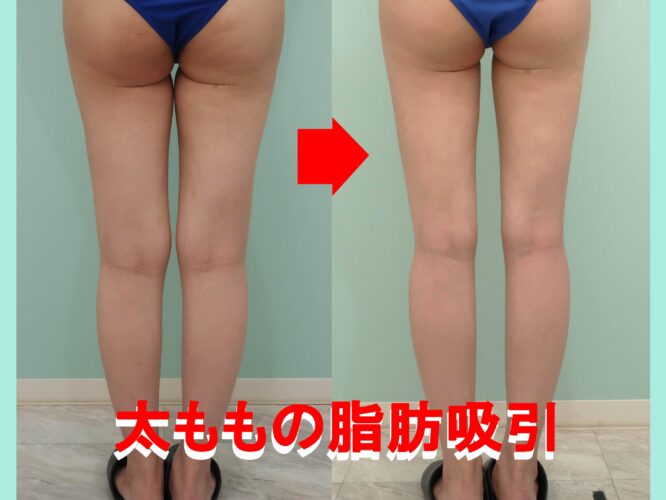 太もも脂肪吸引手術前後写真