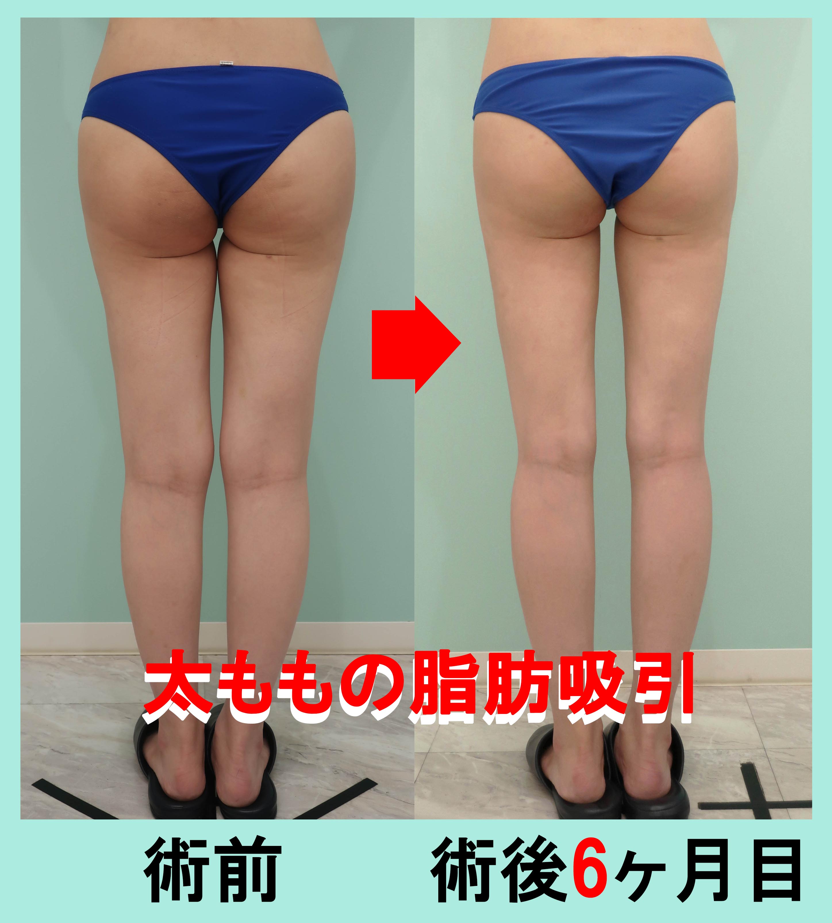 太もも脂肪吸引手術前後写真