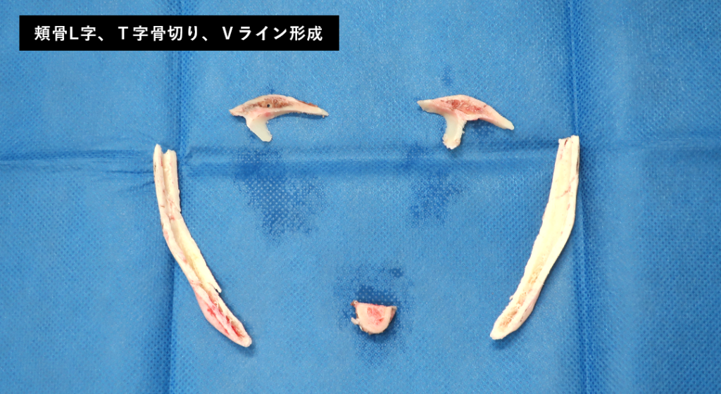 【リベンジハウス】20509 輪郭3点(Vライン形成・オトガイT字骨切り・頬骨L字骨切り)、頬・顎下の脂肪吸引・頬コケ・額こめかみ脂肪注入