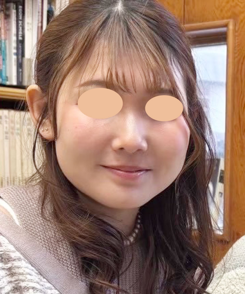 人生変わる小顔術 BEFORE写真