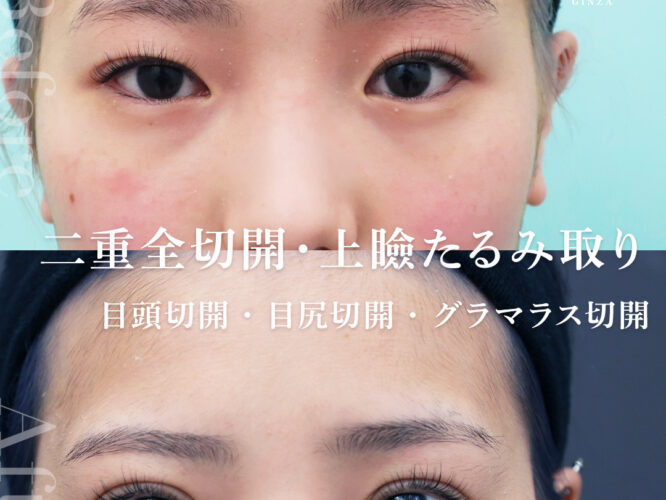 目フル整形　眼瞼下垂　全切開　目尻切開　目頭切開　グラマラスライン
