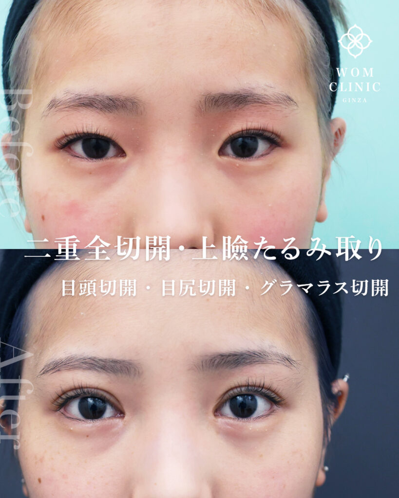 目フル整形　眼瞼下垂　全切開　目尻切開　目頭切開　グラマラスライン