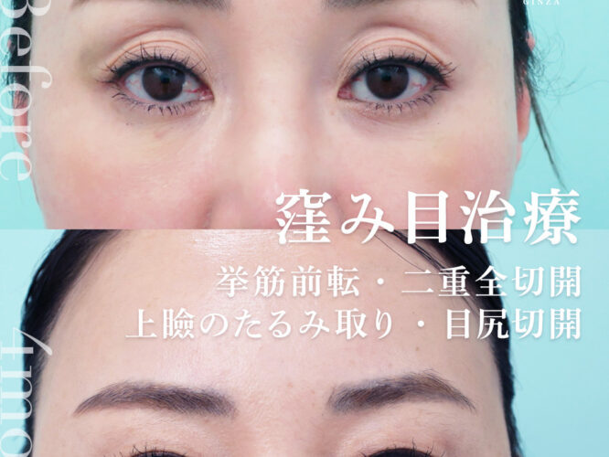くぼみ目　眼瞼下垂　sunken eye　目尻切開