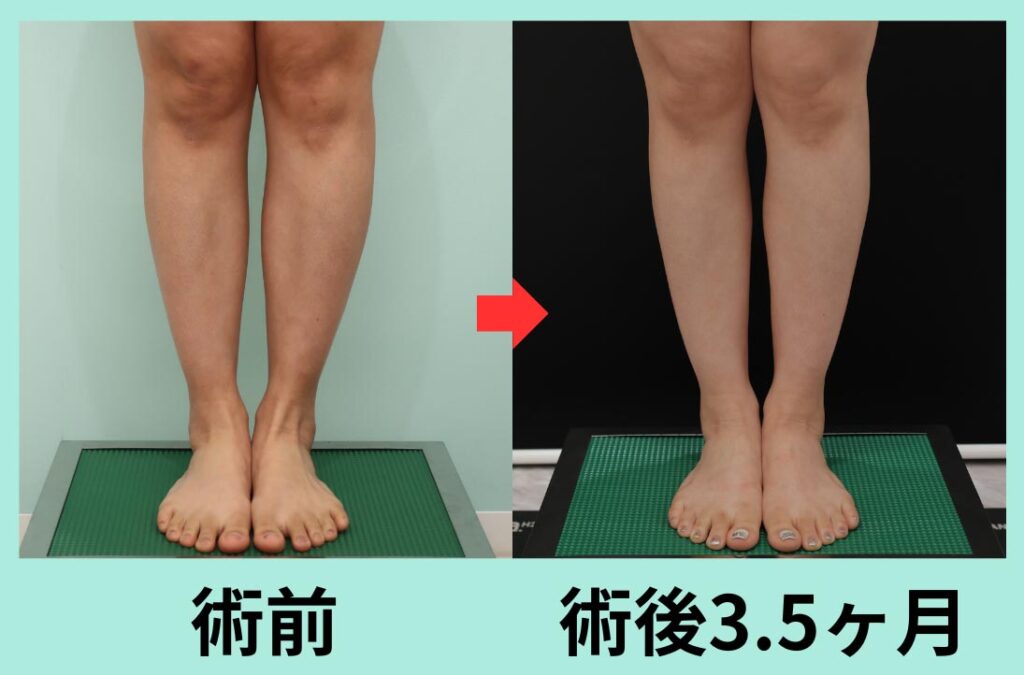ふくらはぎの脂肪吸引