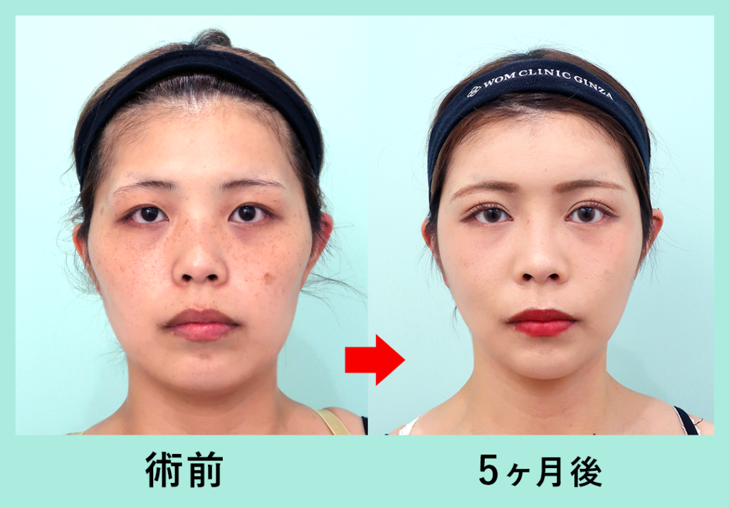 【リベンジハウス】20509 輪郭3点(Vライン形成・オトガイT字骨切り・頬骨L字骨切り)、頬・顎下の脂肪吸引・頬コケ・額こめかみ脂肪注入