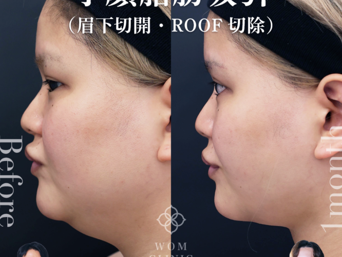 顎下脂肪吸引　ペリカン手術　眉下切開　roof切除