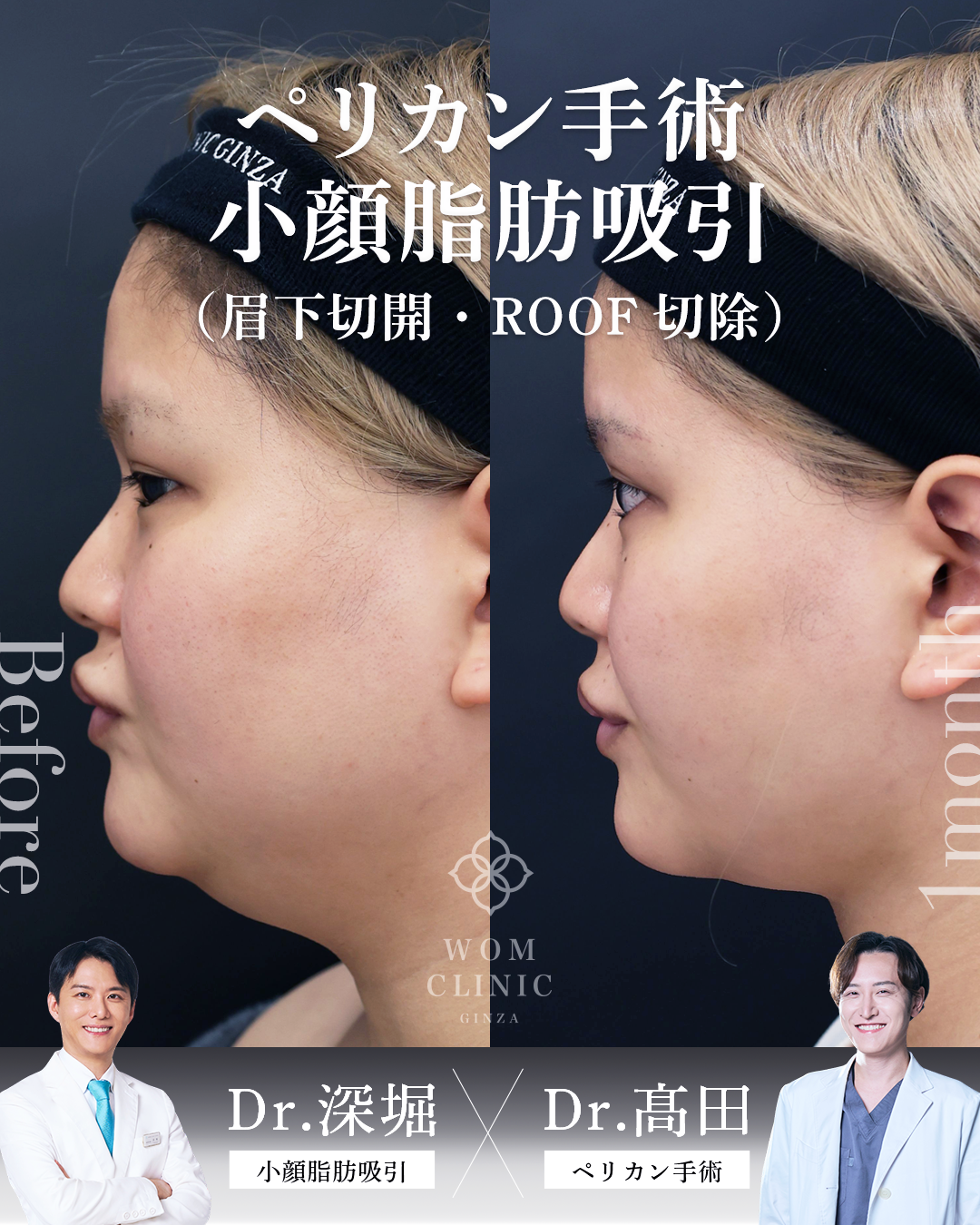 顎下脂肪吸引　ペリカン手術　眉下切開　roof切除