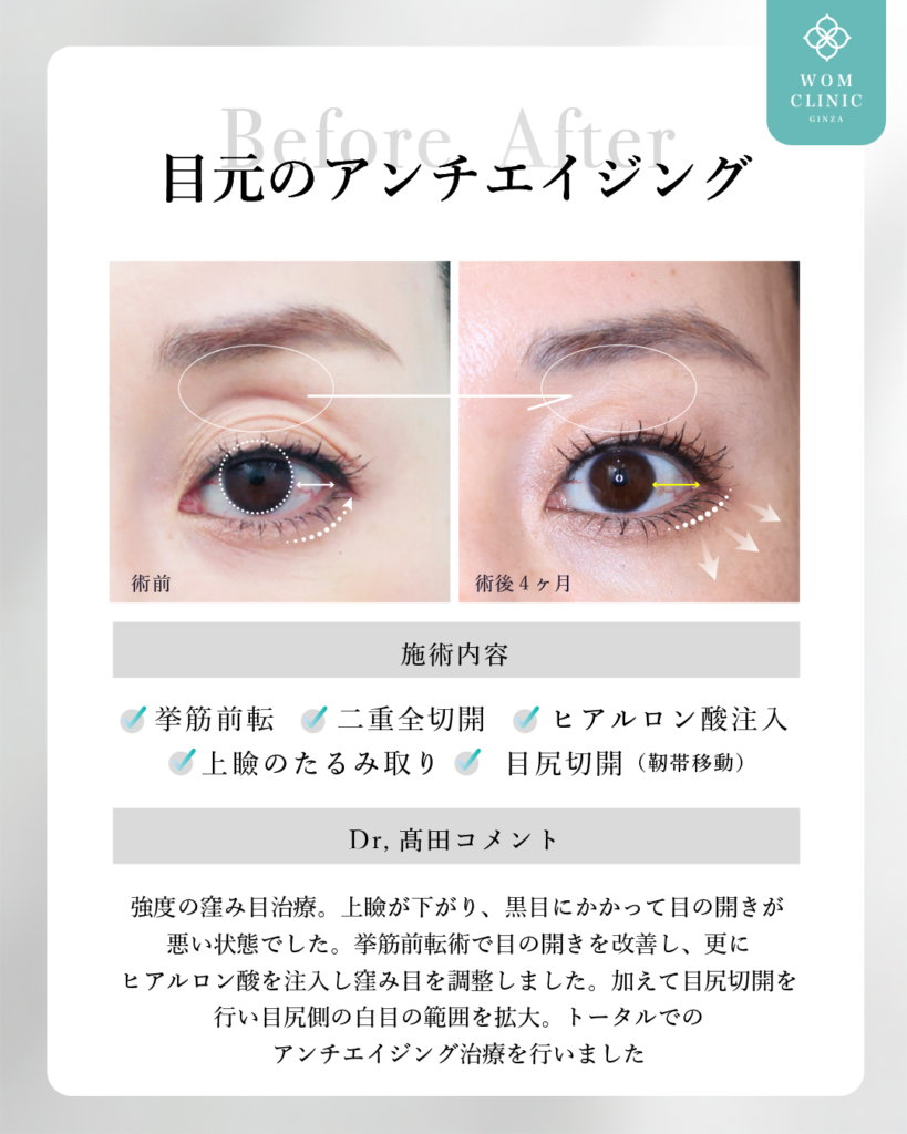 くぼみ目 眼瞼下垂 sunken eye 目尻切開