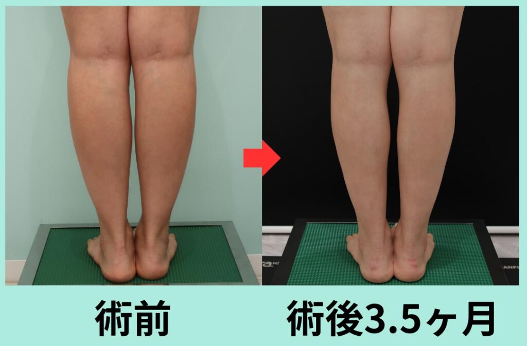 ふくらはぎの脂肪吸引