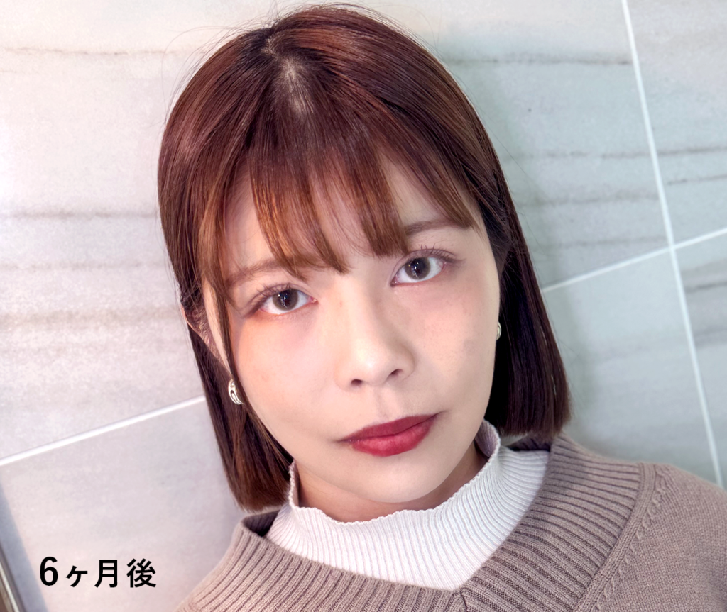 【リベンジハウス】20509 輪郭3点(Vライン形成・オトガイT字骨切り・頬骨L字骨切り)、頬・顎下の脂肪吸引・頬コケ・額こめかみ脂肪注入
