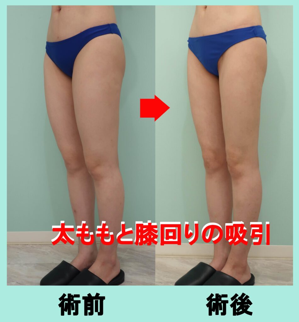 太もも脂肪吸引手術前後写真