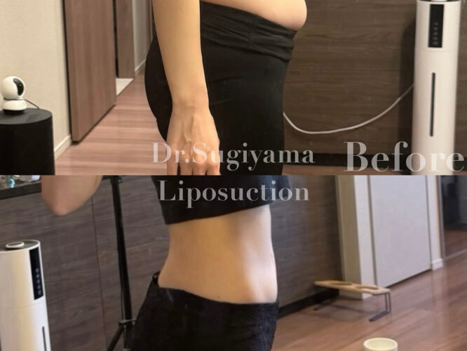 22060 お腹脂肪吸引　腰脂肪吸引　お腹ぽっこり脂肪吸引