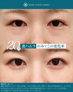 裏ハムラ　術後1ヶ月後