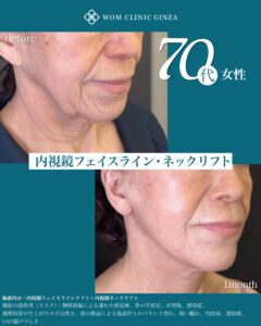 内視鏡フェイスライン、ネックリフト 術後1ヶ月