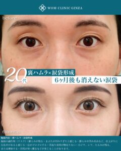 裏ハムラ 涙袋形成 ナノリッチ