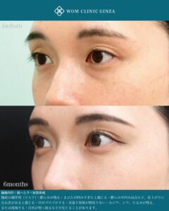裏ハムラ 涙袋形成 ナノリッチ 術後6ヶ月