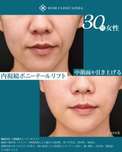内視鏡ポニーテールリフト 術後1週間