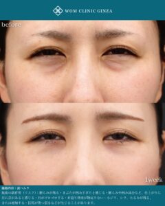 裏ハムラ　ダウンタイム　術後１週間