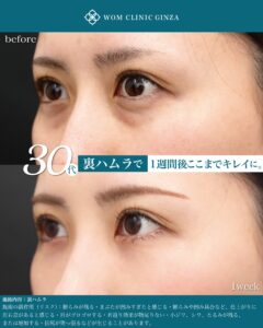 裏ハムラ　ダウンタイム　術後１週間
