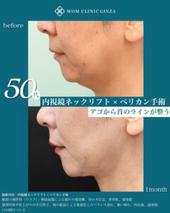 内視鏡ネックリフト、ペリカンリフト、術後9ヶ月