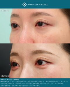裏ハムラ 涙袋形成 術後3w