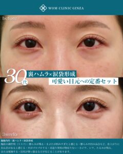 裏ハムラ 涙袋形成 術後3w