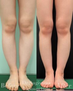 22564 ふくらはぎ脂肪吸引　下腿脂肪吸引　足首脂肪吸引