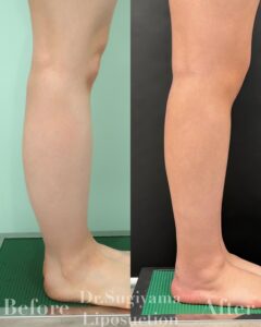 『【症例解説】ふくらはぎ脂肪吸引の劇的変化と、誰も教えてくれない「2つの秘密」』の画像