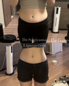 『ぽっこりお腹をぺったんこに！お腹脂肪吸引のリアルな変化を日常写真でお届けします』の画像