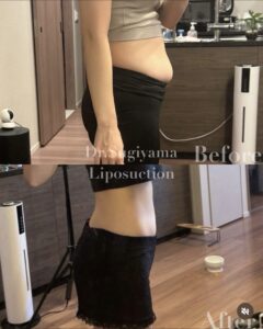『ぽっこりお腹をぺったんこに！お腹脂肪吸引のリアルな変化を日常写真でお届けします』の画像