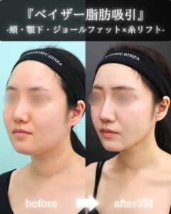 頬 顎下 脂肪吸引 ジョールファット 糸リフト