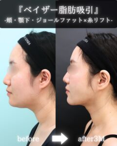『【ベイザー脂肪吸引×糸リフト】“もたつき”を滑らかに極限まで改善』の画像