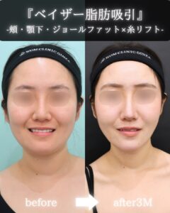 『【ベイザー脂肪吸引×糸リフト】“もたつき”を滑らかに極限まで改善』の画像