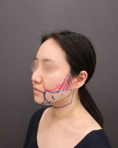 『【ベイザー脂肪吸引×糸リフト】“もたつき”を滑らかに極限まで改善』の画像