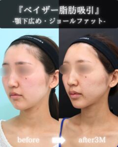 『“痩せる”ではなく、“フェイスラインを洗練させる”小顔脂肪吸引』の画像