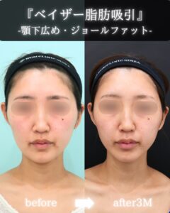『“痩せる”ではなく、“フェイスラインを洗練させる”小顔脂肪吸引』の画像
