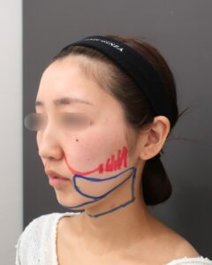 『“痩せる”ではなく、“フェイスラインを洗練させる”小顔脂肪吸引』の画像