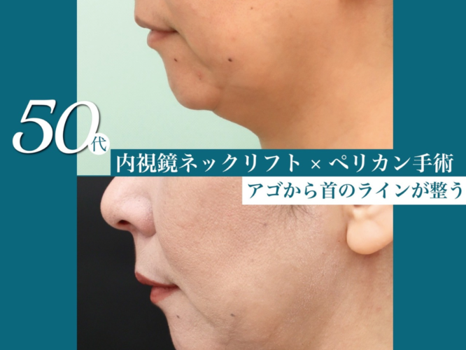 内視鏡ネックリフト、ペリカンリフト、術後9ヶ月