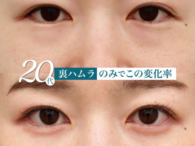 裏ハムラ　術後1ヶ月後