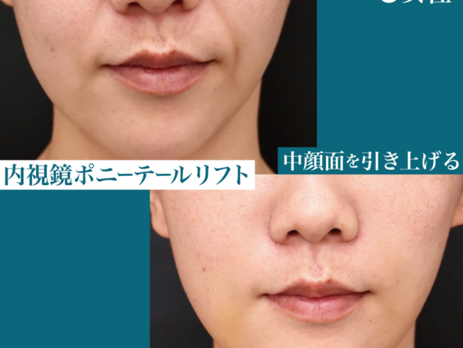 内視鏡ポニーテールリフト 術後１週間