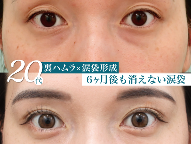 裏ハムラ　涙袋形成　ナノリッチ 術後6ヶ月
