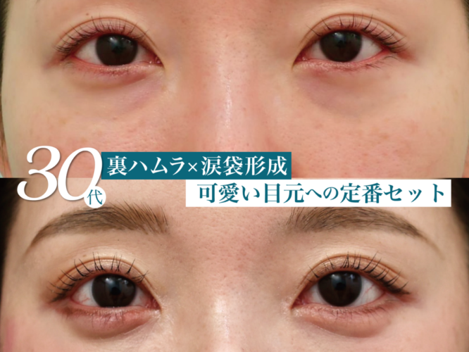 裏ハムラ 涙袋形成　術後3w