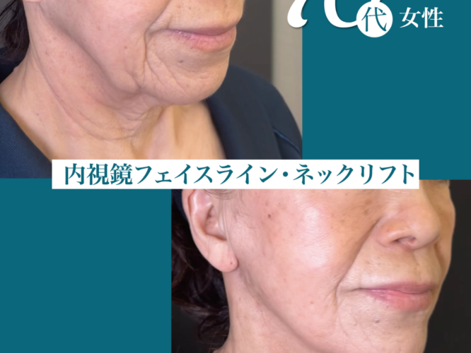 内視鏡フェイスライン、ネックリフト　術後1ヶ月