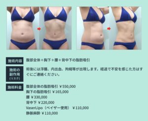 腹部の脂肪吸引のビフォーアフター